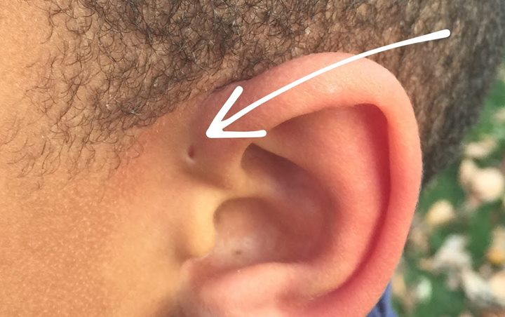 4. Lubang Kecil Tambahan di Telinga