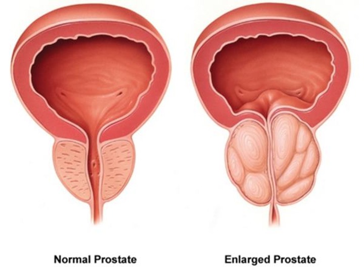 Bawang Merah Sembuhkan Kanker Prostat