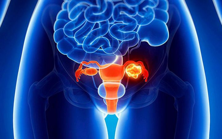 9 Tanda Awal Gejala Kanker Ovarium yang Sering Diabaikan Wanita