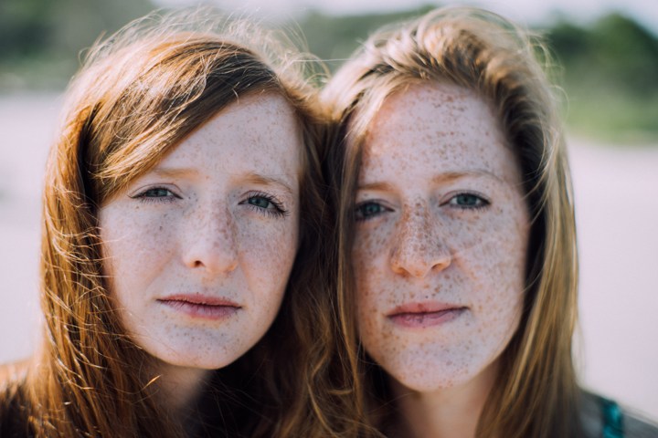 Munculnya Freckles Dipicu Karena Faktor Genetik