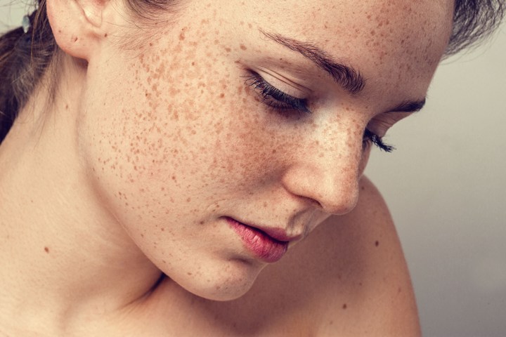 Freckles Tidak Berbahaya dan Dapat Dicegah