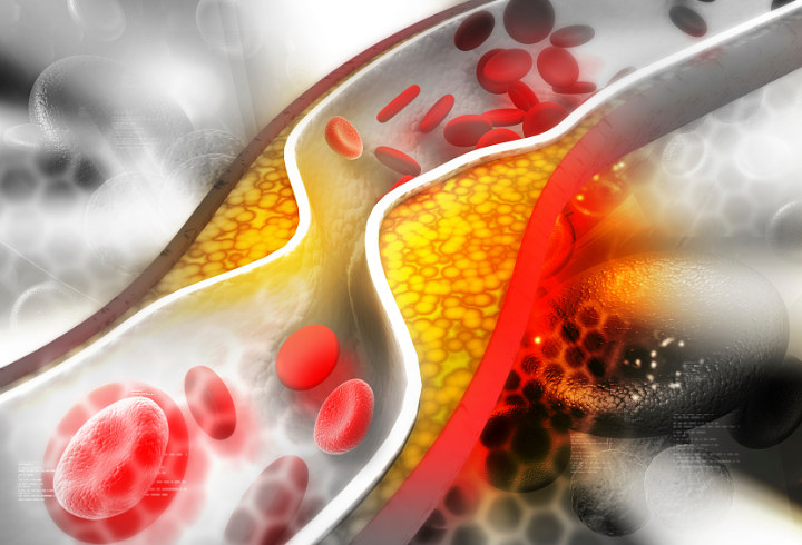 Kolesterol Jahat dapat Diatasi dengan Beras Merah
