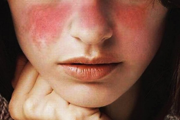 Lupus Adalah Penyakit Autoimun Yang Sering Ditemui Di Indonesia