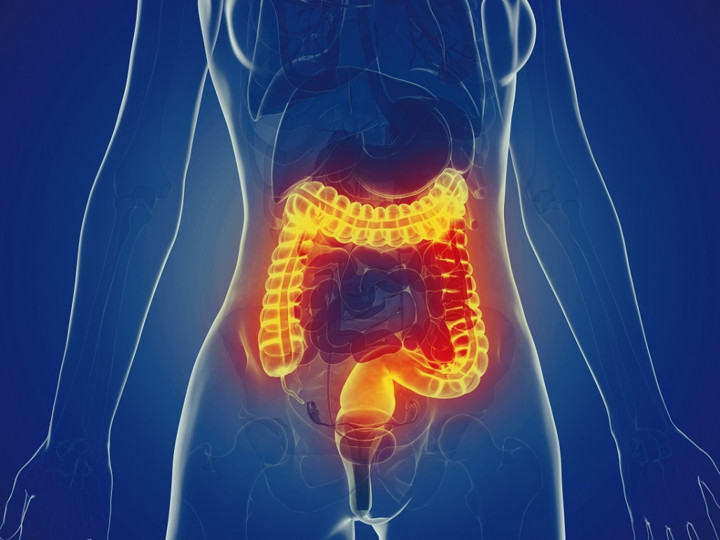 Inflammatory Bowel Disease (IBD) Atau Radang Usus Juga Bisa Disebabkan Autoimun