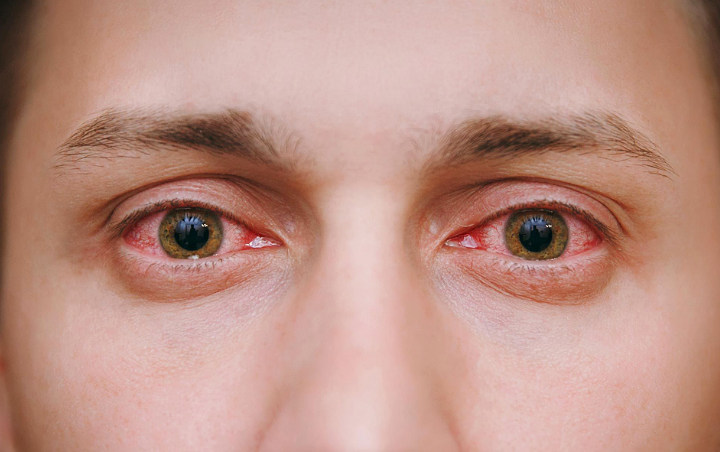 Sakit Mata Disebut Ada Kaitannya Dengan COVID-19, Berikut Penjelasannya