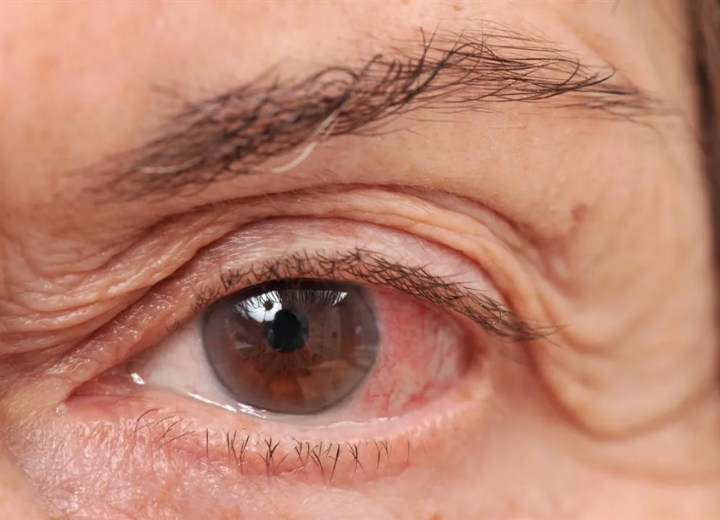 Lakukan Berbagai Tindakan Pencegahan Ini Jika Tak Ingin Tertular   Virus Corona Lewat Mata