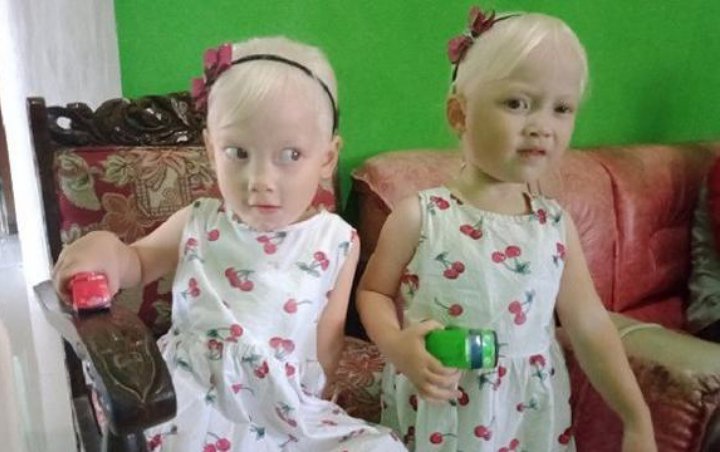 Viral Anak Kembar Albino Asli Wonogiri Dikira Bule, Orang Tua Sering Disangka Pembantu