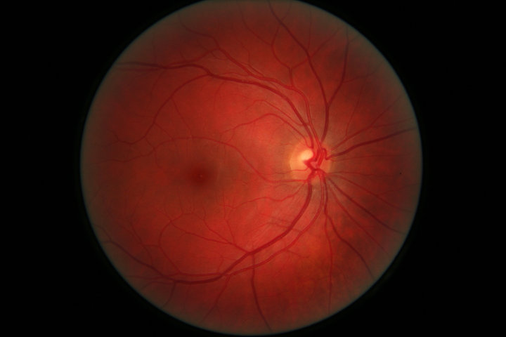 Merusak Retina