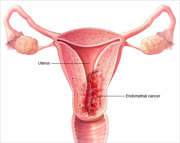 Kanker Endometrium
