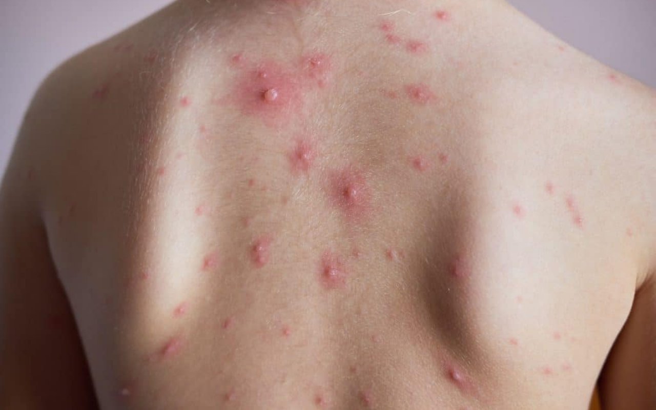 chicken-pox-scars