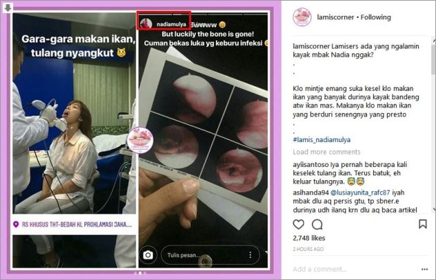 Duri Ikan Tersangkut di  Tenggorokan  Nadia Mulya Harus 